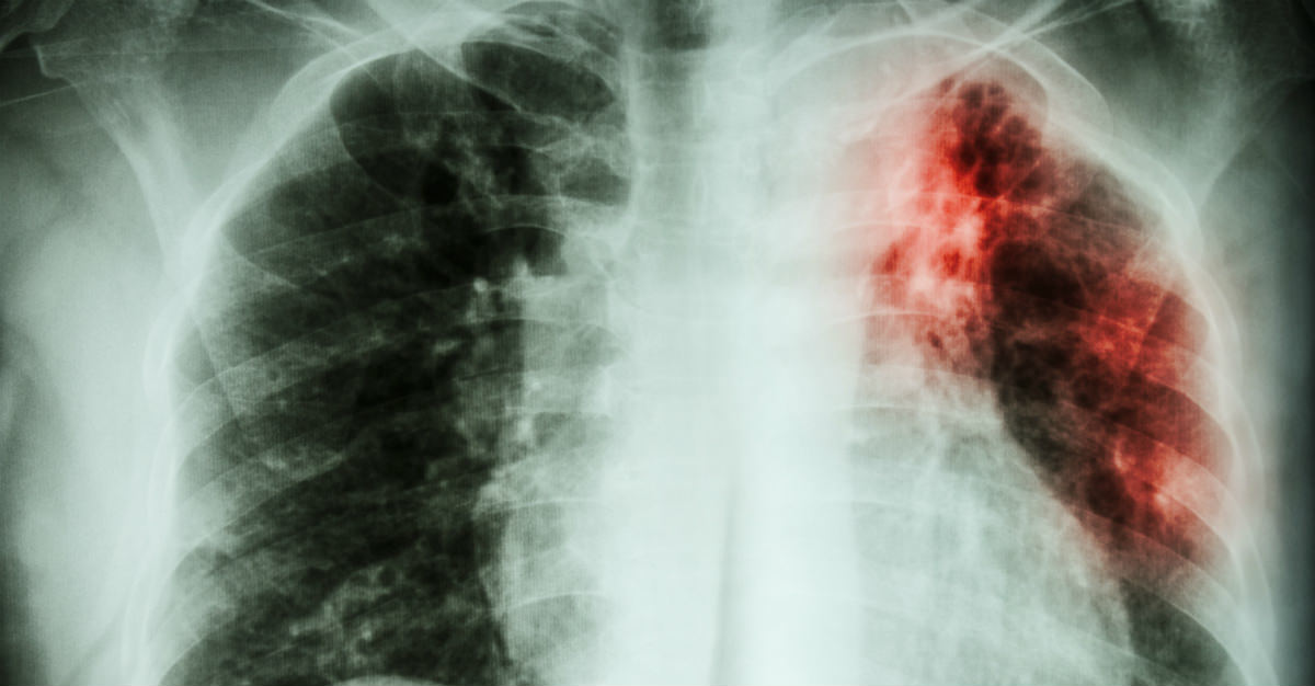 La tuberculose ne doit pas être considérée comme une autre maladie éradiquée.