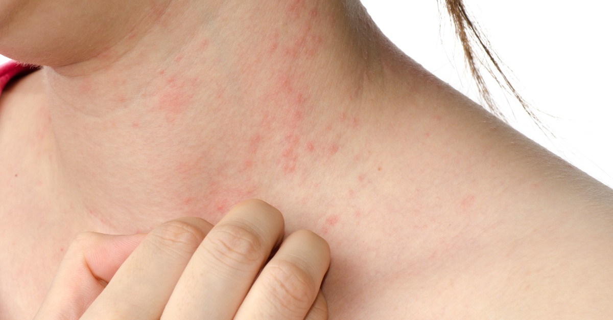 Hives appear to be an uncommon sign of influenza.