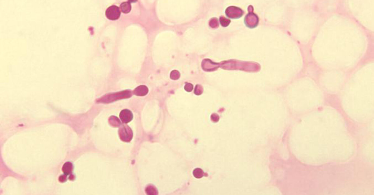 Malassezia furfur in skin scale from a patient with tinea versicolor PHIL 3938 lores