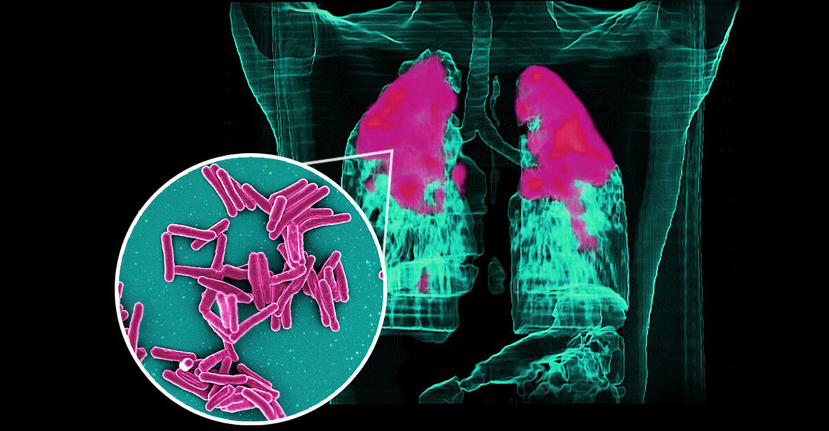 A new TB treatment may be a lifesaver for many.